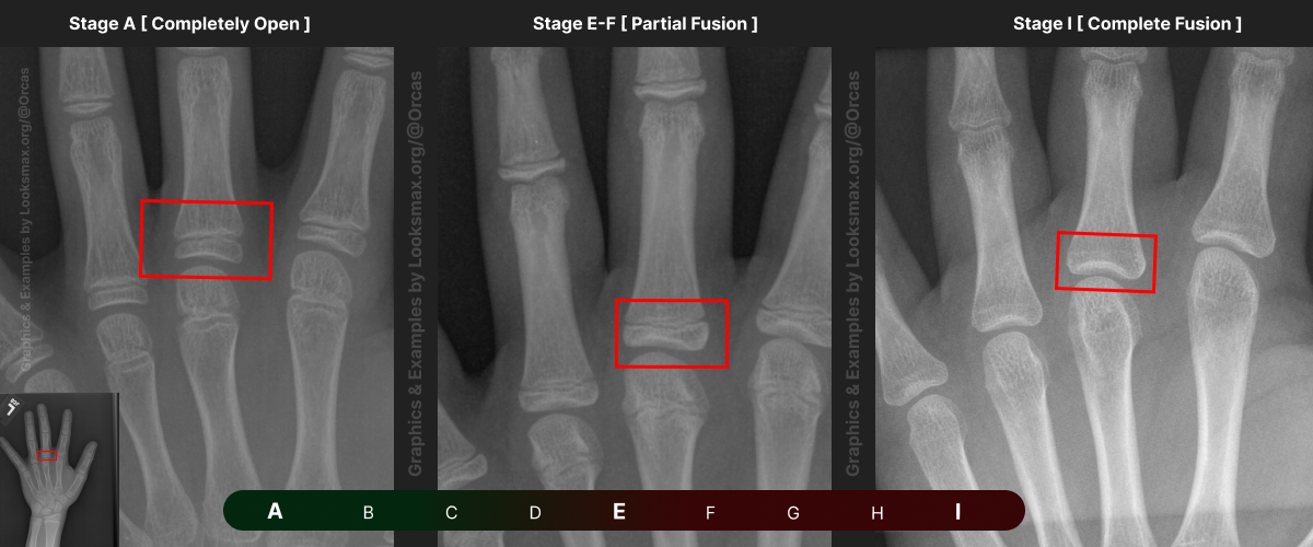 Template 4  Bonetype  3rd Metacarpal middle finger
