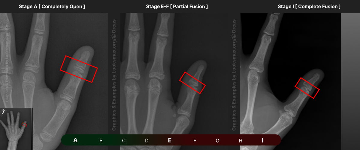 Template 6  Bonetype  1st Proximal Phalanx