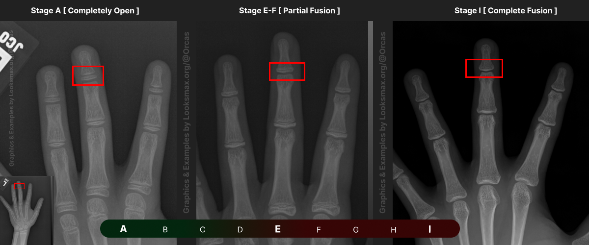 Template 7  Bonetype  3rd Proximal Phalanx