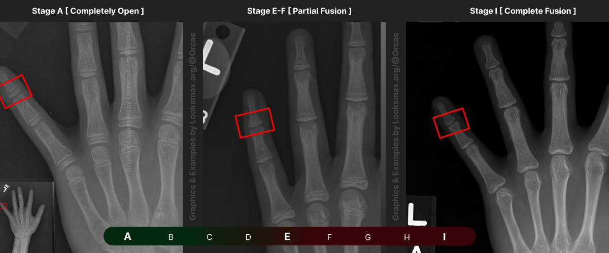 Template 8  Bonetype  5th Proximal Phalanx