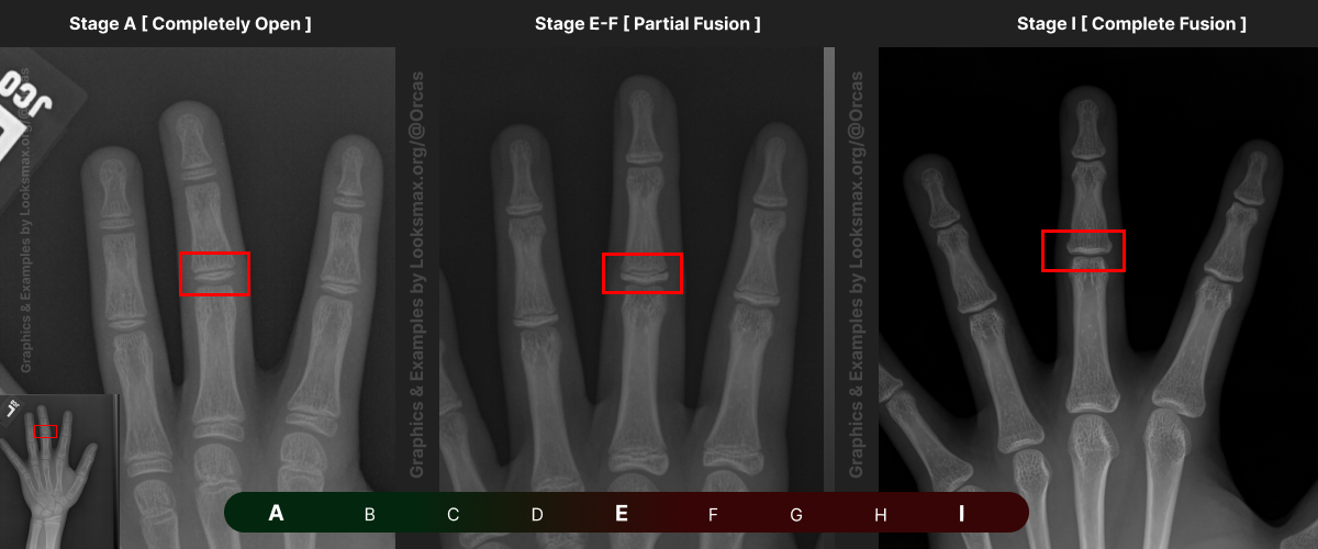 Template 9  Bonetype  3rd Middle Phalanx