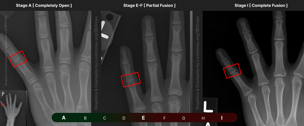 Template 10  Bonetype  5th Middle Phalanx