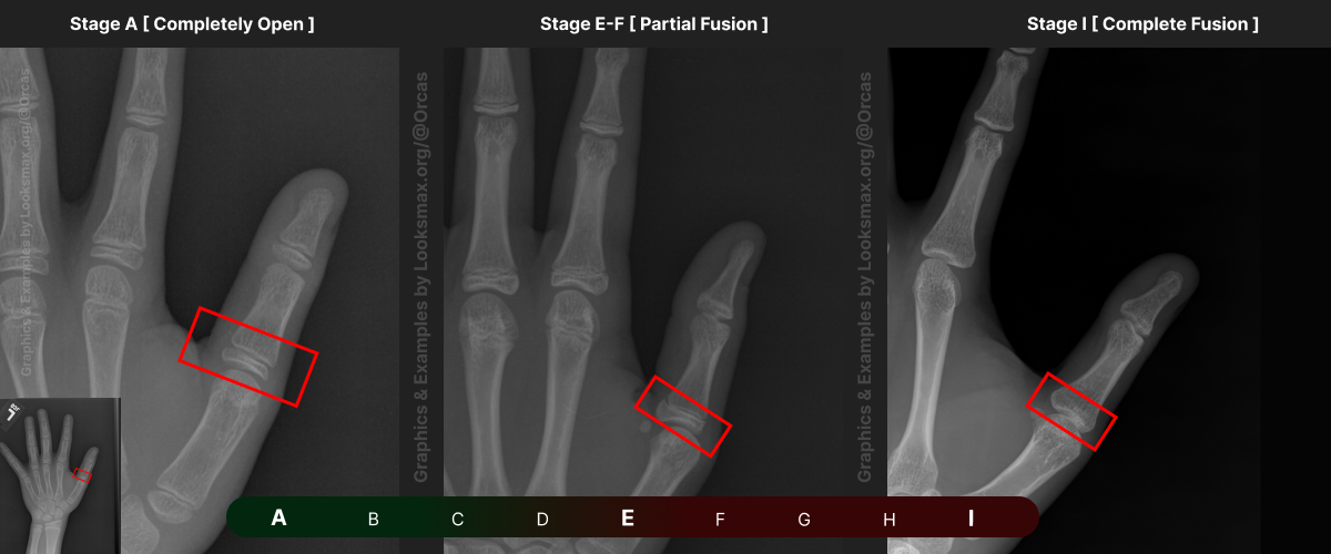 Template 11  Bonetype  1st Distal Phalanx thumb