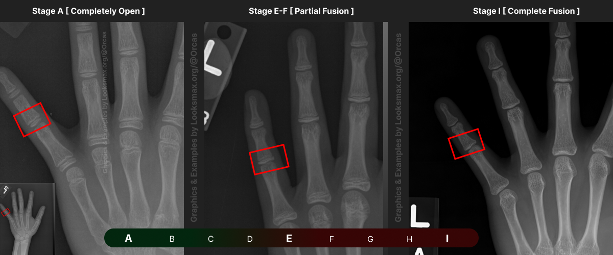 Template 13  Bonetype  5th Distal Phalanx pinky