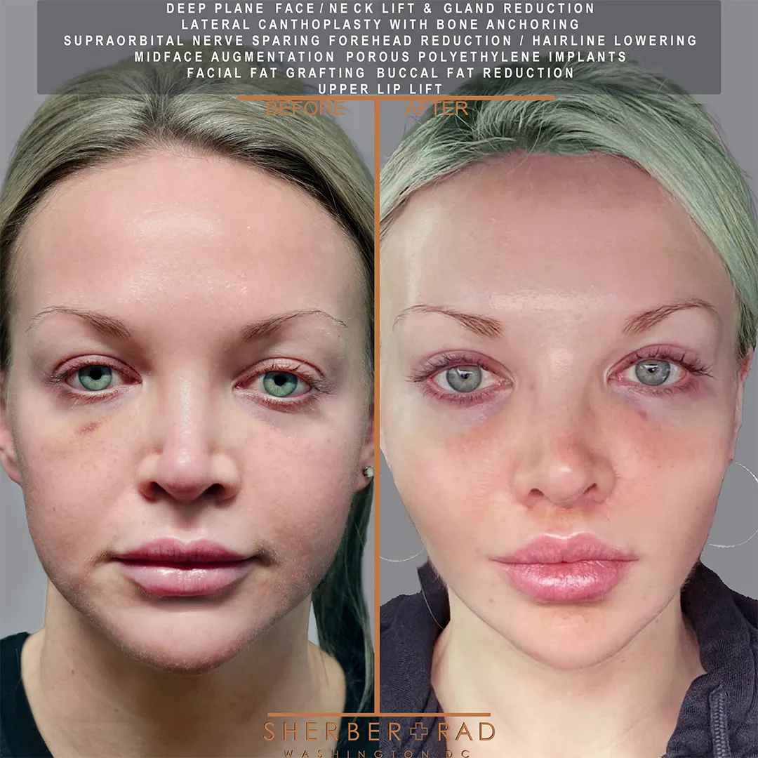 11214 1of2 Facial Implants before and after photos by Sherber and Rad in Washington DC