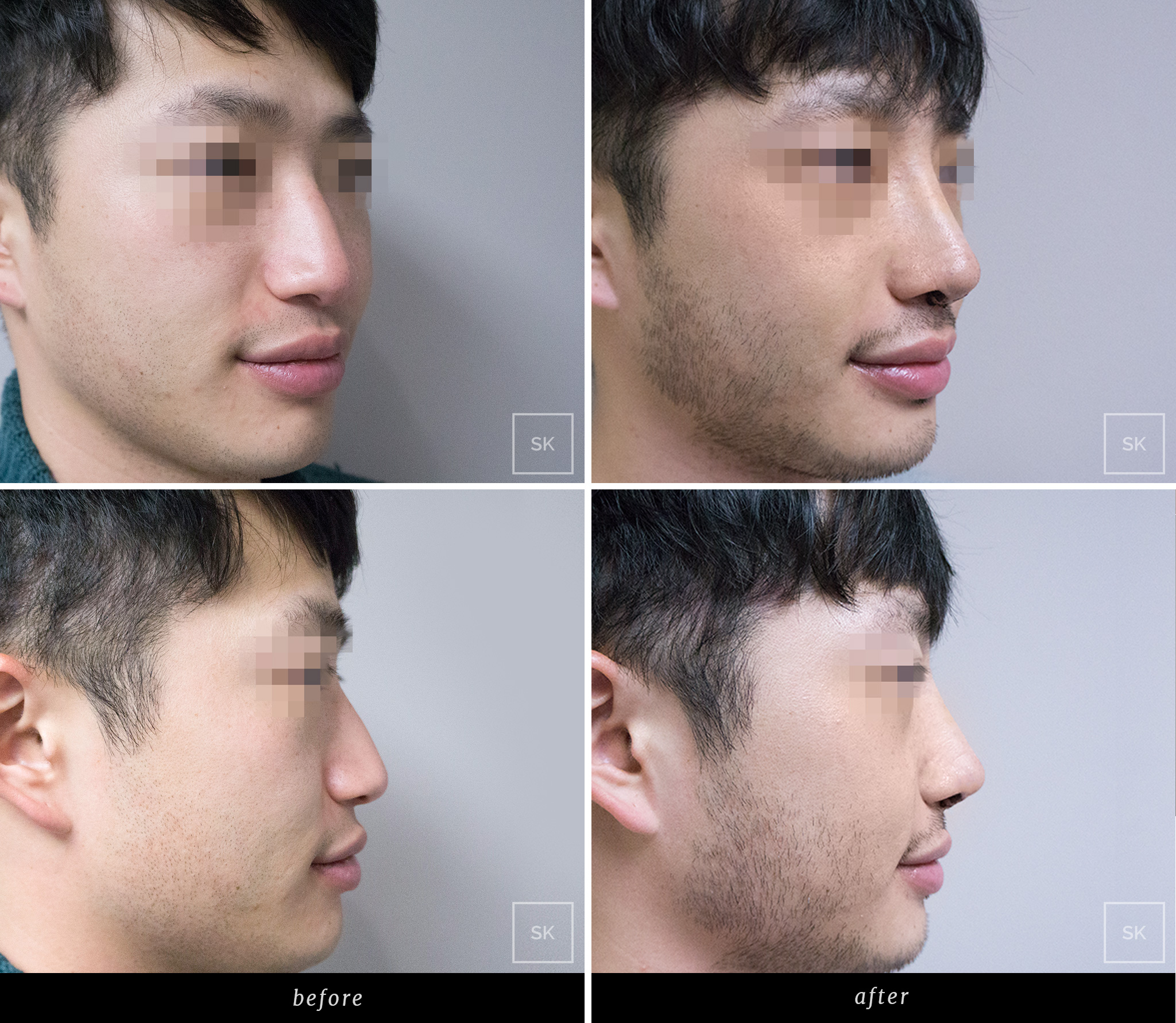 5ce8499063d91e359858045d SK Plastic Surgery Rhinoplasty Before and After 8