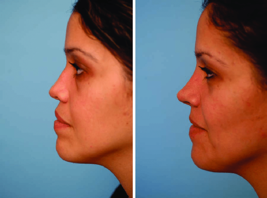 Case 1 Left Preoperative nasal dorsal and premaxillary deficiency Right Five years
