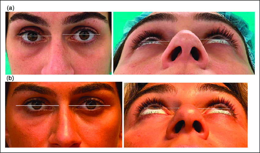 Clinical examination a Before surgery the patient exhibited enophthalmos upper eyelid