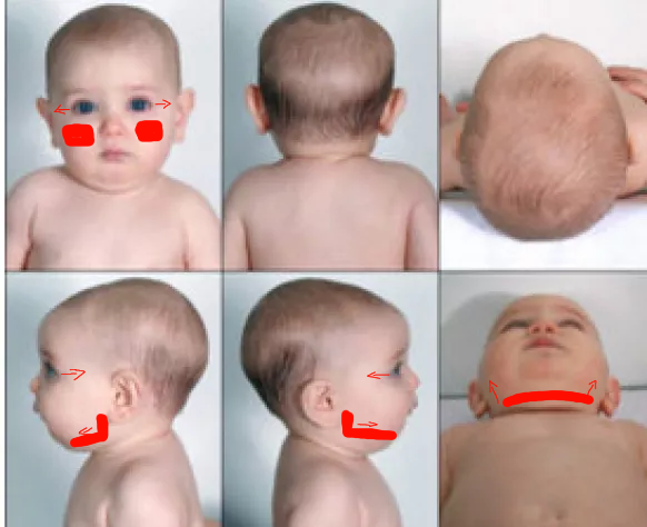 NormalHeadShape 6months