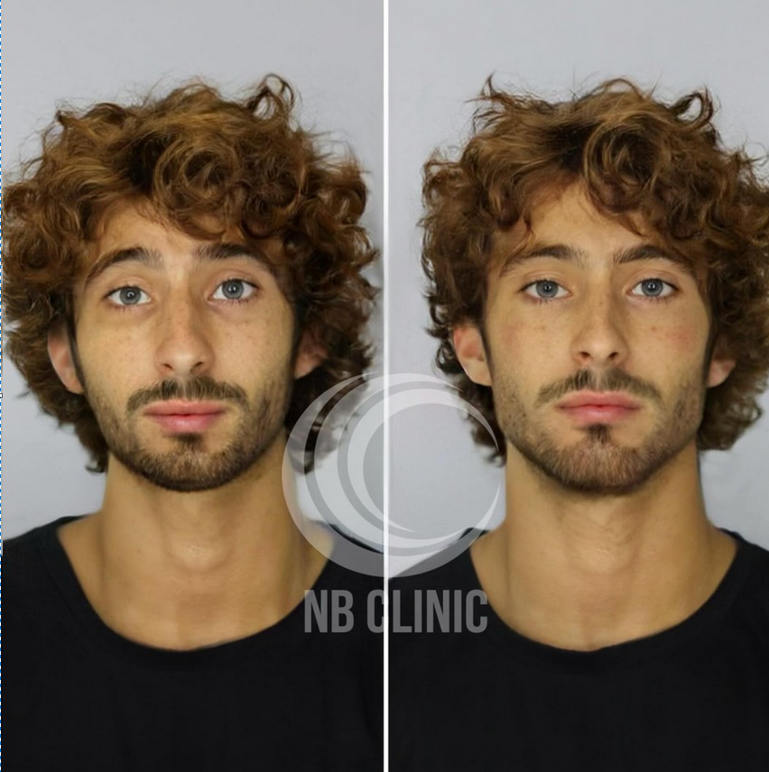 Filler results