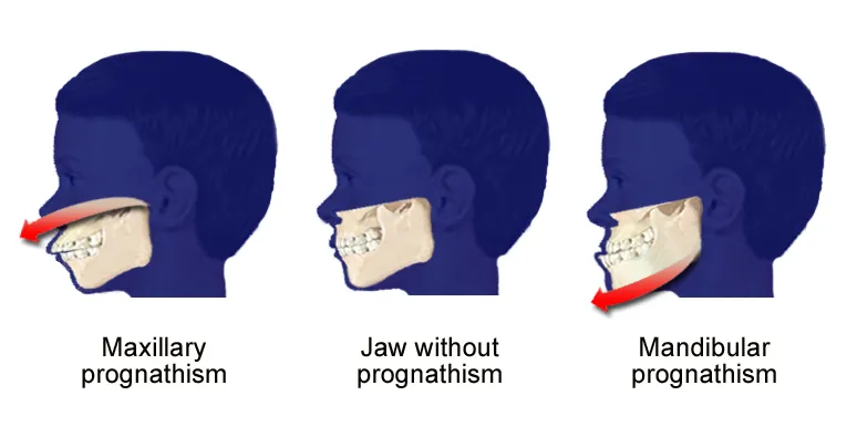 Prognathism3 1