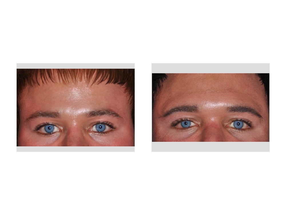 Brone Bone Implant result front vie