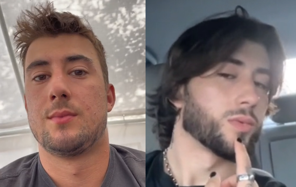 Cheek implant results