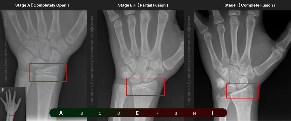Template 1_ Bonetype_ Radius (distal end).png