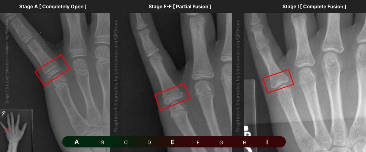 Template 5_ Bonetype_ 5th Metacarpal (pinky).png