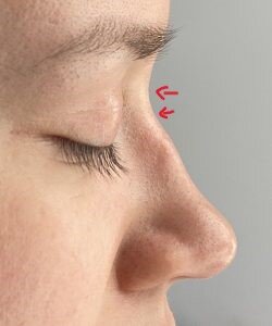 example nasal bs.jpg