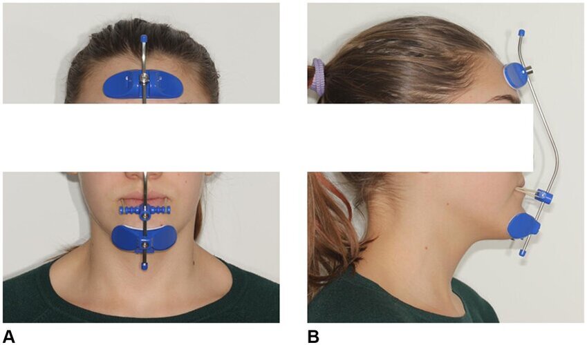 Patient-wearing-the-facemask-A-Frontal-view-B-Lateral-view.jpg