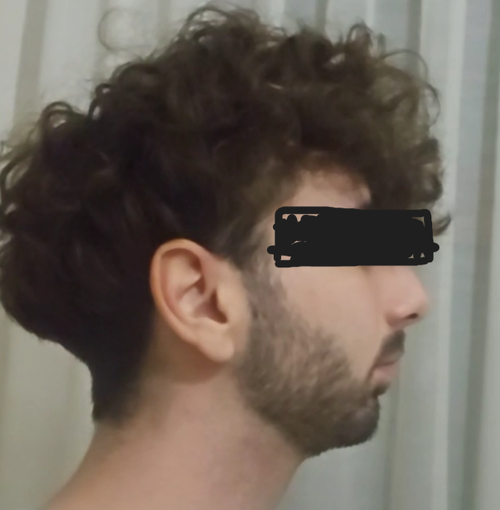 recessed jawline - Copia.png