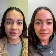 nose reduction 1.jpg