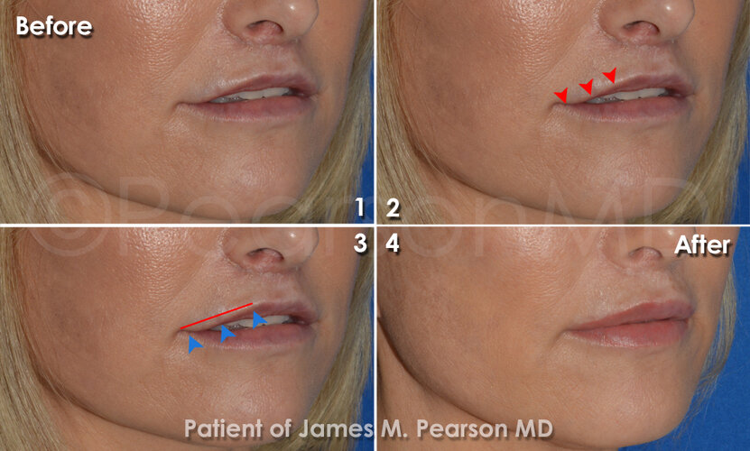 corner-lip-lift.jpg