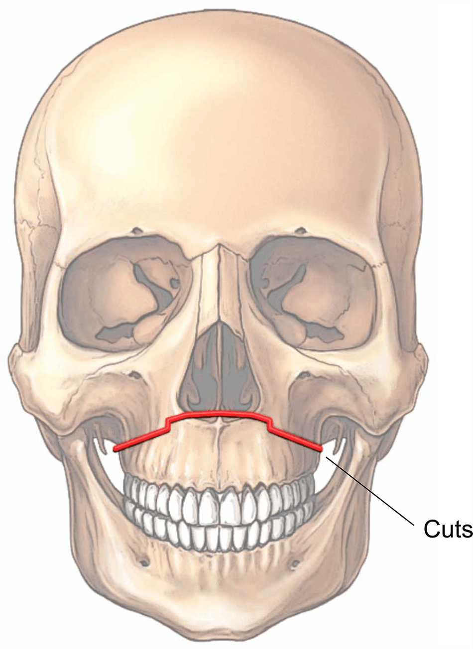 Maxillary le fort illustration 92a268
