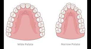 Narrow Palate and Sleep Apnea: What You ...