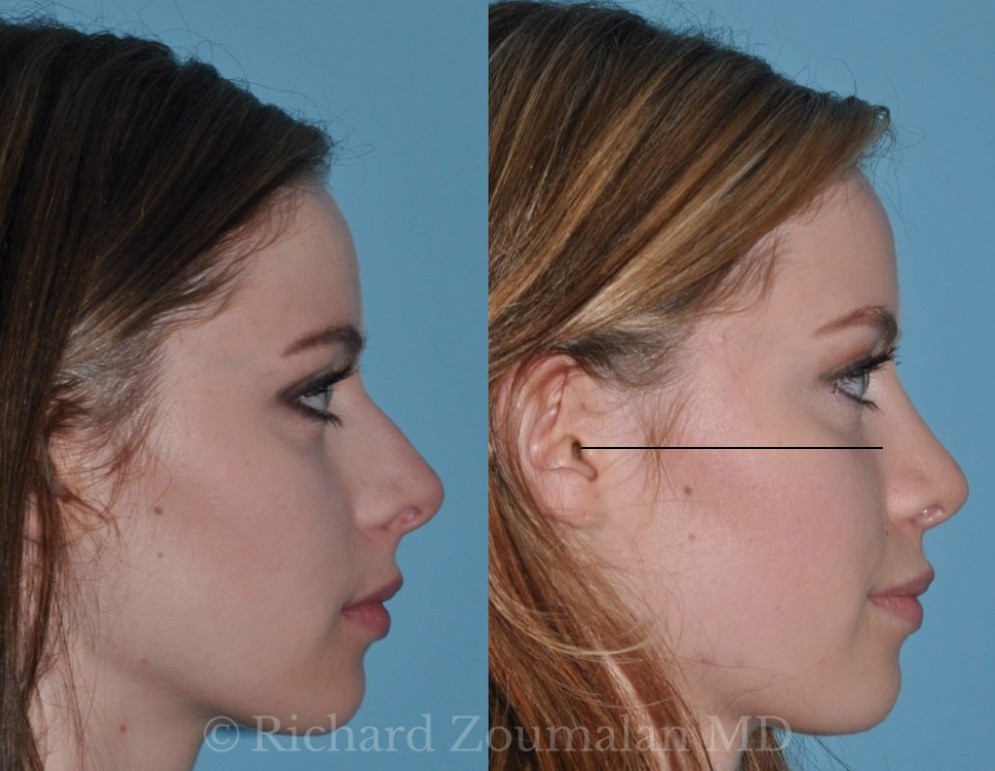 Rhinoplasty frankfurt horizontal plane