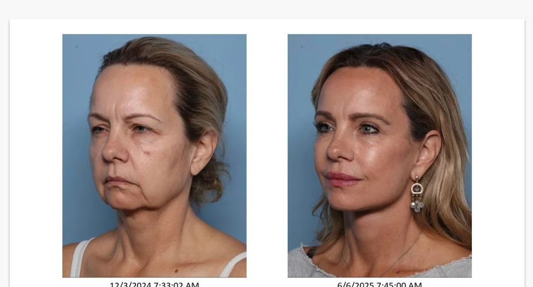 6 month post op 54 years old v0 askiin27yt5f1