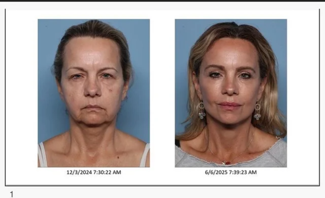 6 month post op 54 years old v0 05zw3n27yt5f1