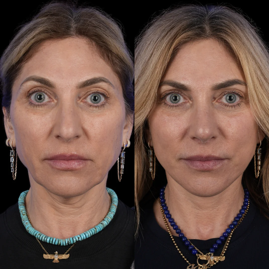Facelift brow lift fat grafting revision rhinoplasty 4 v0 ly00k5q5315g1