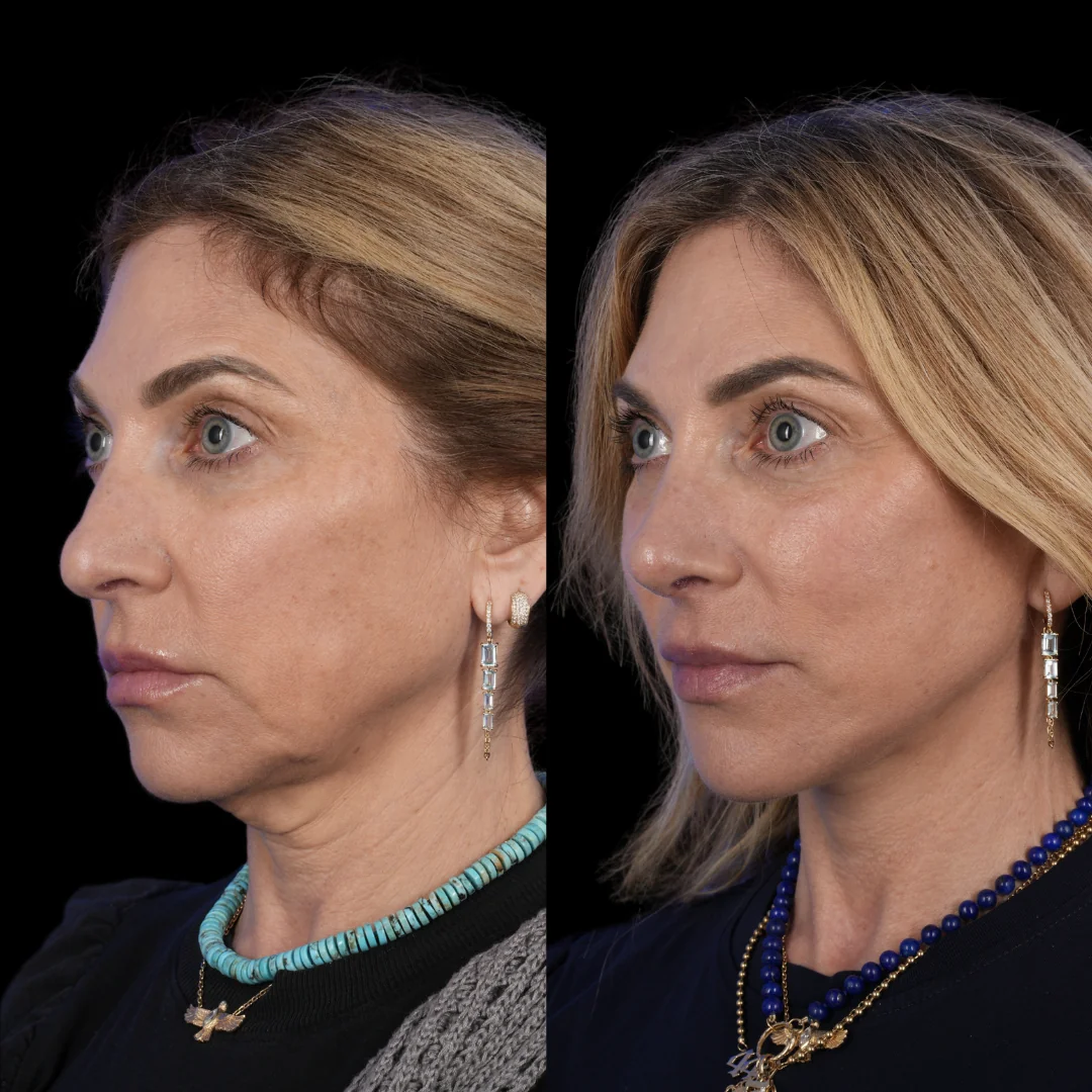Facelift brow lift fat grafting revision rhinoplasty 4 v0 vxuur3q5315g1