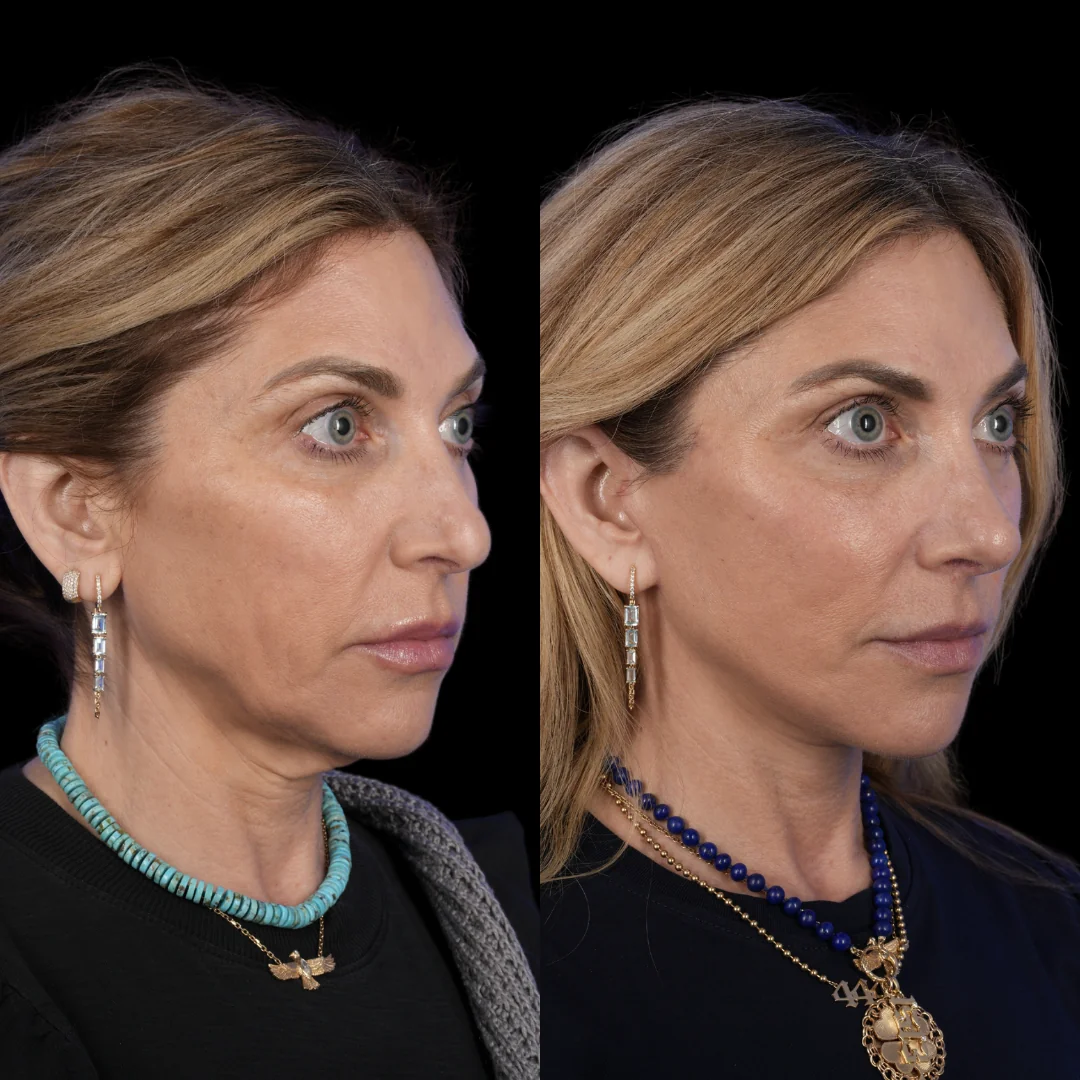 Facelift brow lift fat grafting revision rhinoplasty 4 v0 u012w7q5315g1