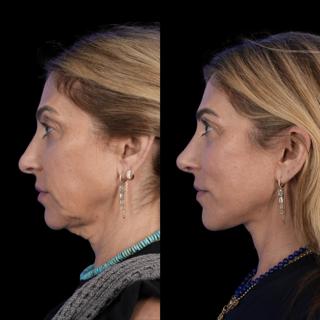 Facelift brow lift fat grafting revision rhinoplasty 4 v0 zpynl4q5315g1