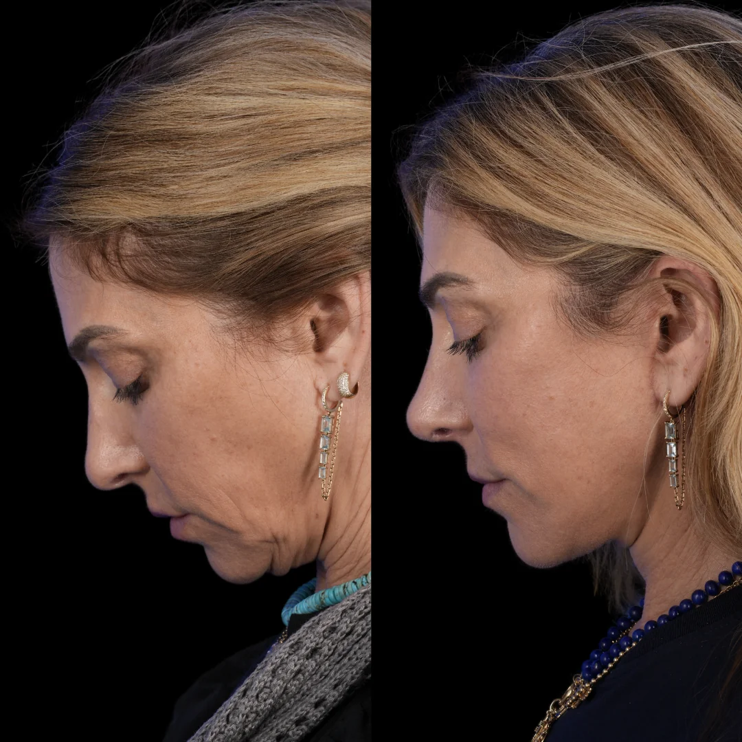 Facelift brow lift fat grafting revision rhinoplasty 4 v0 3ysn68q5315g1