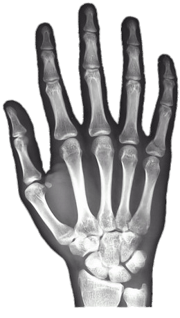Toppngcom x ray of hand 260x460