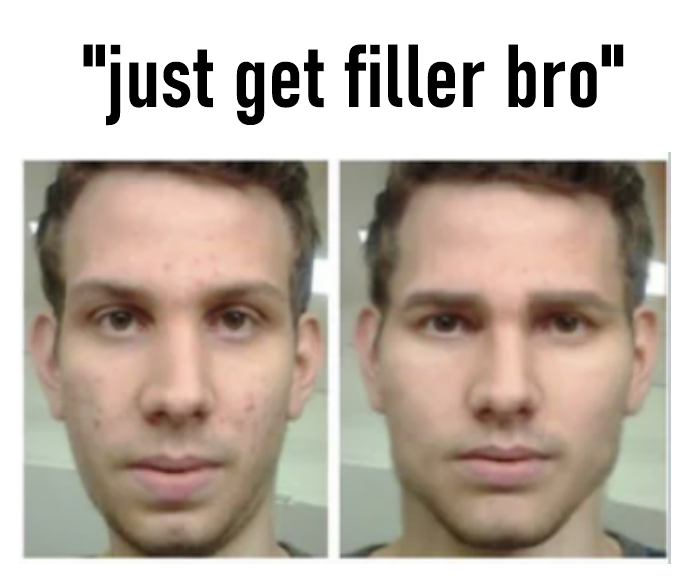 Just get filler