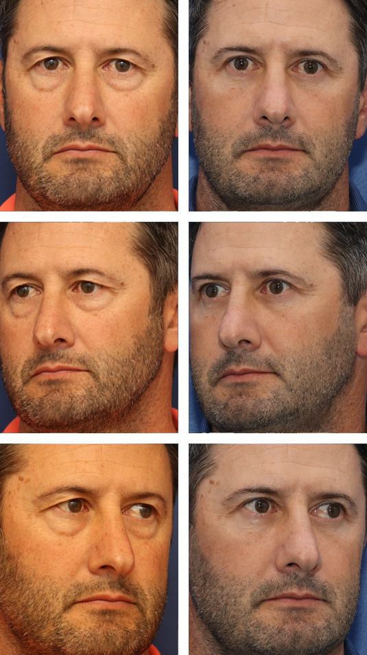 51 Year Old Male Upper and Lower Blepharoplasty