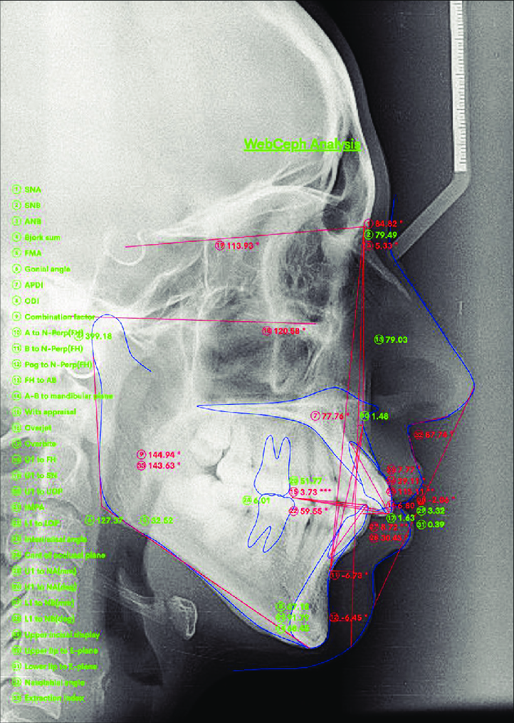 Lateral cephalogram showing WEBCEPH analysis