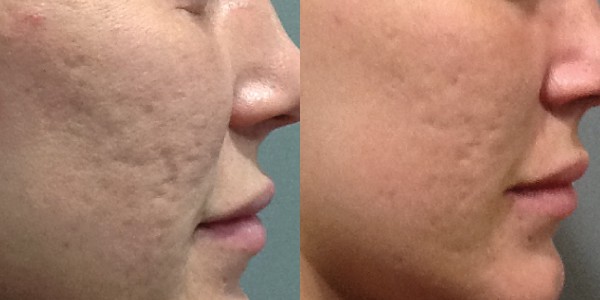 Microneedling before and after