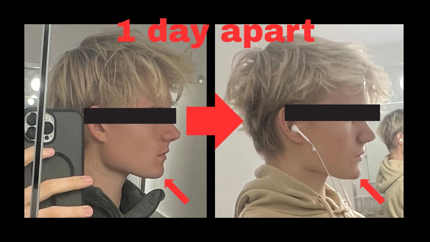 Several MM of inflamed tissue