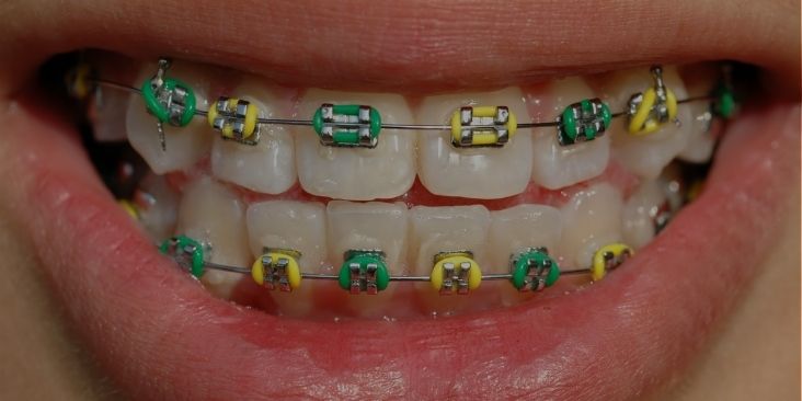 Traditional braces colored bands