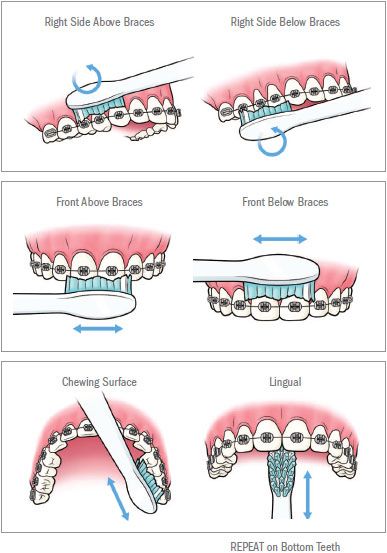 Braces brushing guide