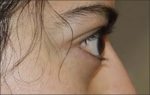 Exophthalmos side view 2 mobile