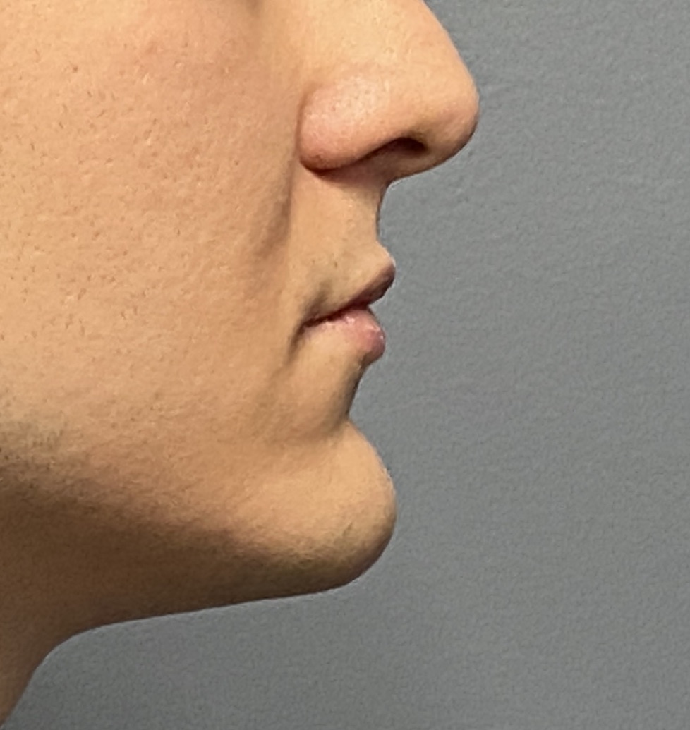 Promiennt male chin side view Dr Barry Eppley
