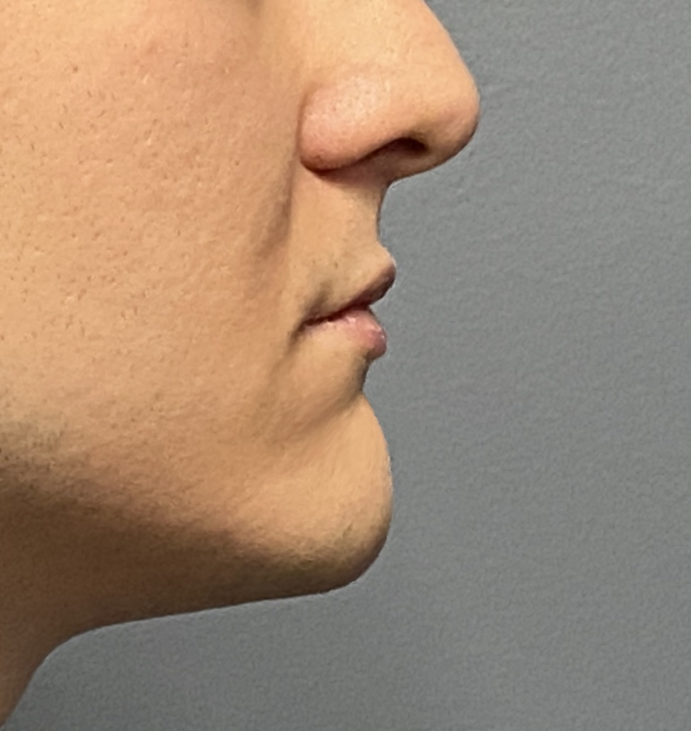 2promiennt male chin side view Dr Barry Eppley