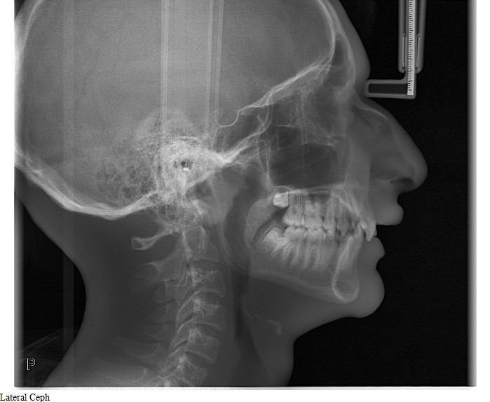 Anagh Bhavsar Lateral Ceph  edited copy