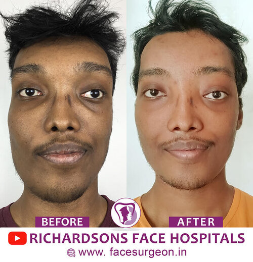 Facial Asymmetry Surgery Front View 1