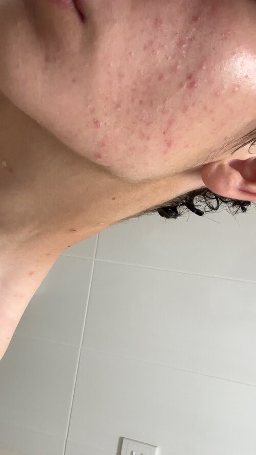 Acne day 1.jpg