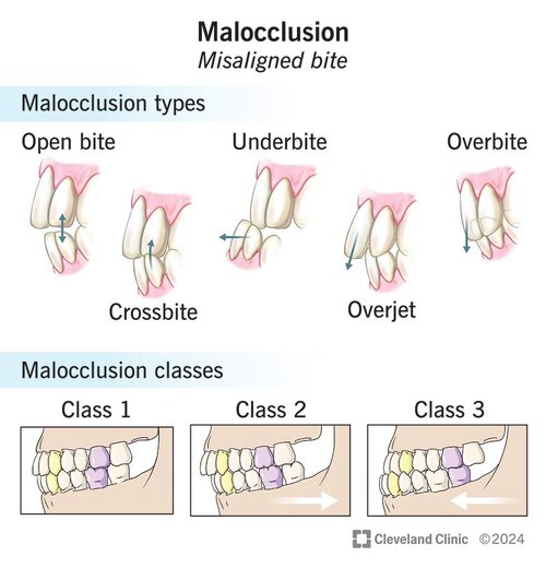 malocclusion.jpg