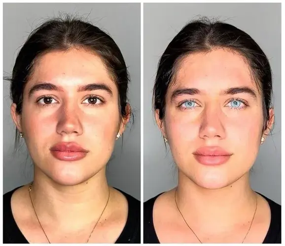 keratopigmentation-not-only-do-they-botch-their-eyes-they-v0-qedaana8noed1.jpg.webp
